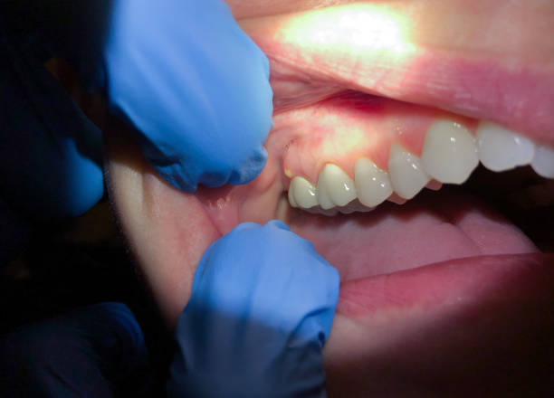 Best Emergency Root Canal Treatment in Huntington, VA